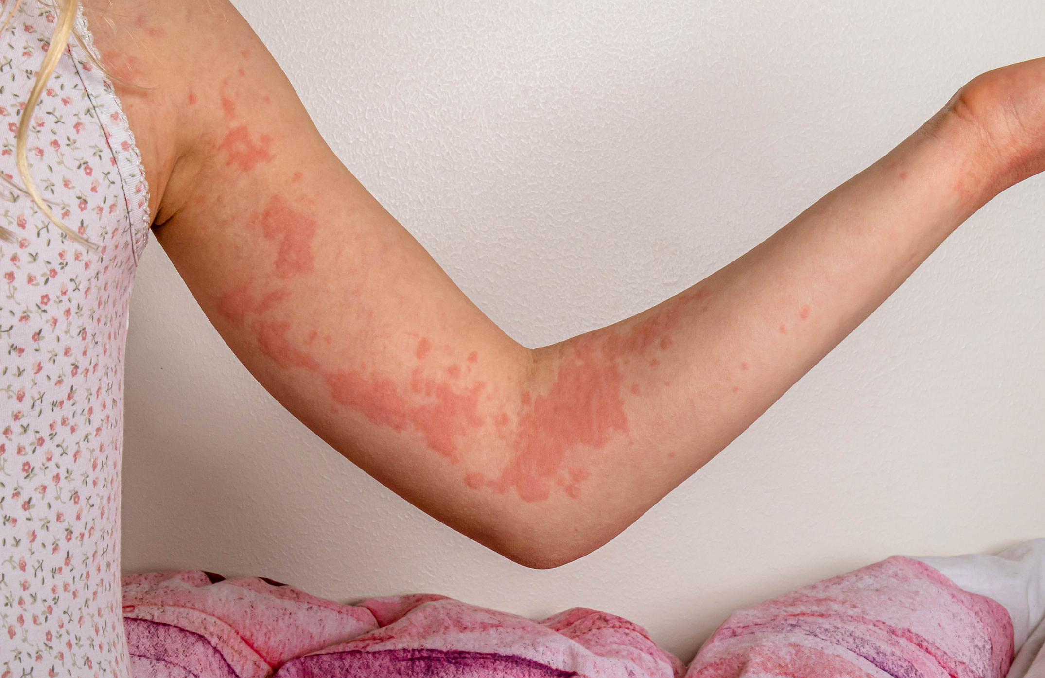 Allakos Doses First Patient in Urticaria Clinical Trial - PRISM MarketView