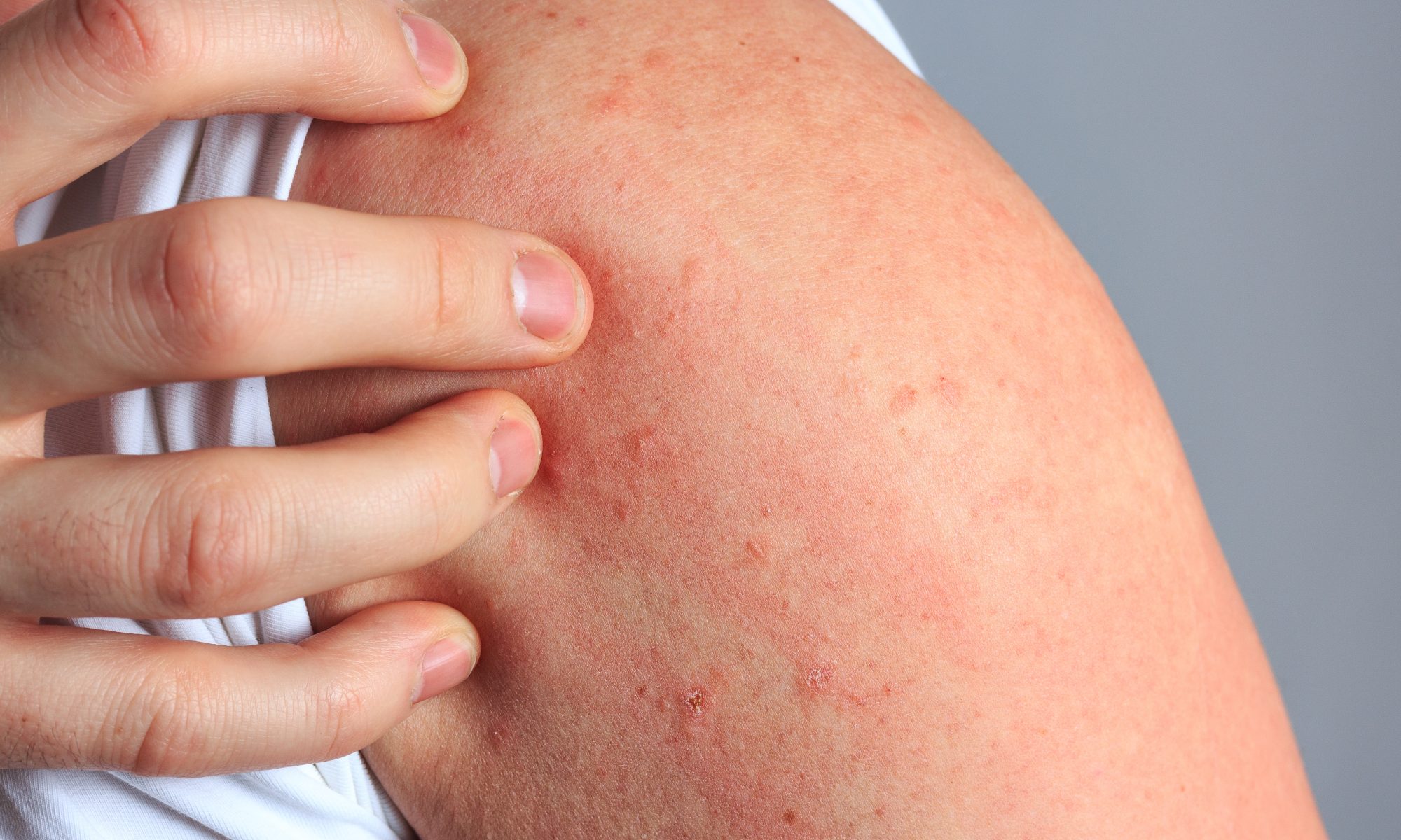Celldex Shares Rise After Data Show Durable Responses in Chronic Hives ...
