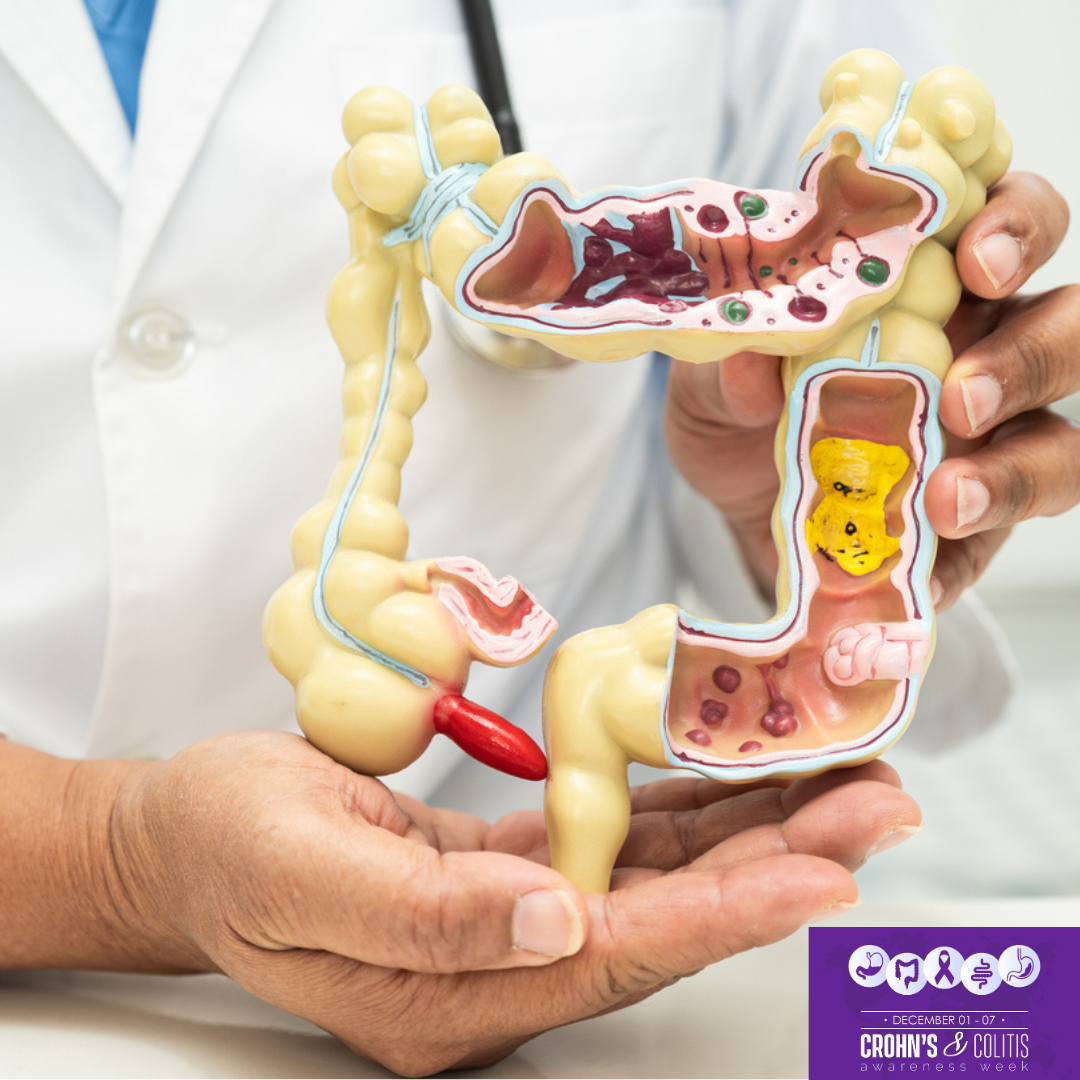 A healthcare professional wearing a white coat holds a detailed anatomical model of the human colon, showing inflamed and diseased sections. The image includes banners referencing Crohn’s & Colitis Awareness Week (December 1–7). Colorful labels with stock tickers “NASDAQ: RDHL,” “NASDAQ: ABVX,” and “NASDAQ: PTGX” appear around the image.