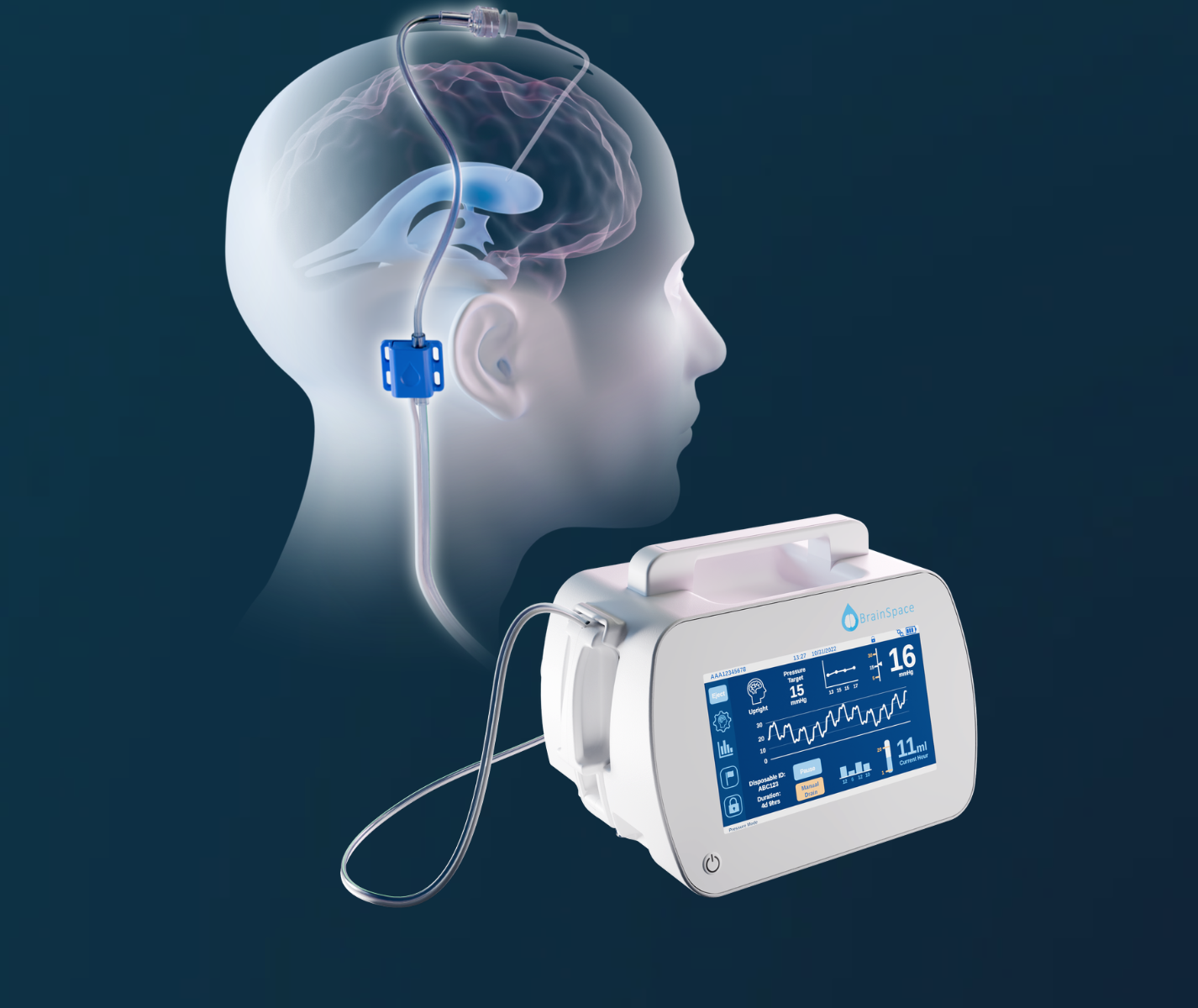 FDA Clears BrainSpaces’ Automated Brain Fluid Management System for ...