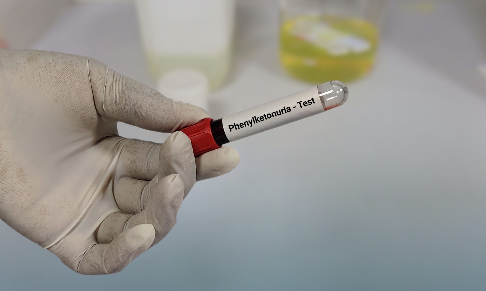 Gloved hand holding a labeled blood sample tube for phenylketonuria (PKU) testing in a clinical laboratory setting.