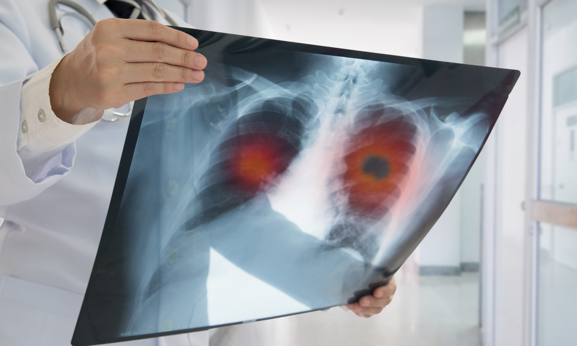 Doctor holding a chest X-ray showing suspicious lung nodules, representing bioAffinity Technologies' CyPath® Lung test for lung cancer risk assessment and pulmonary nodule evaluation.