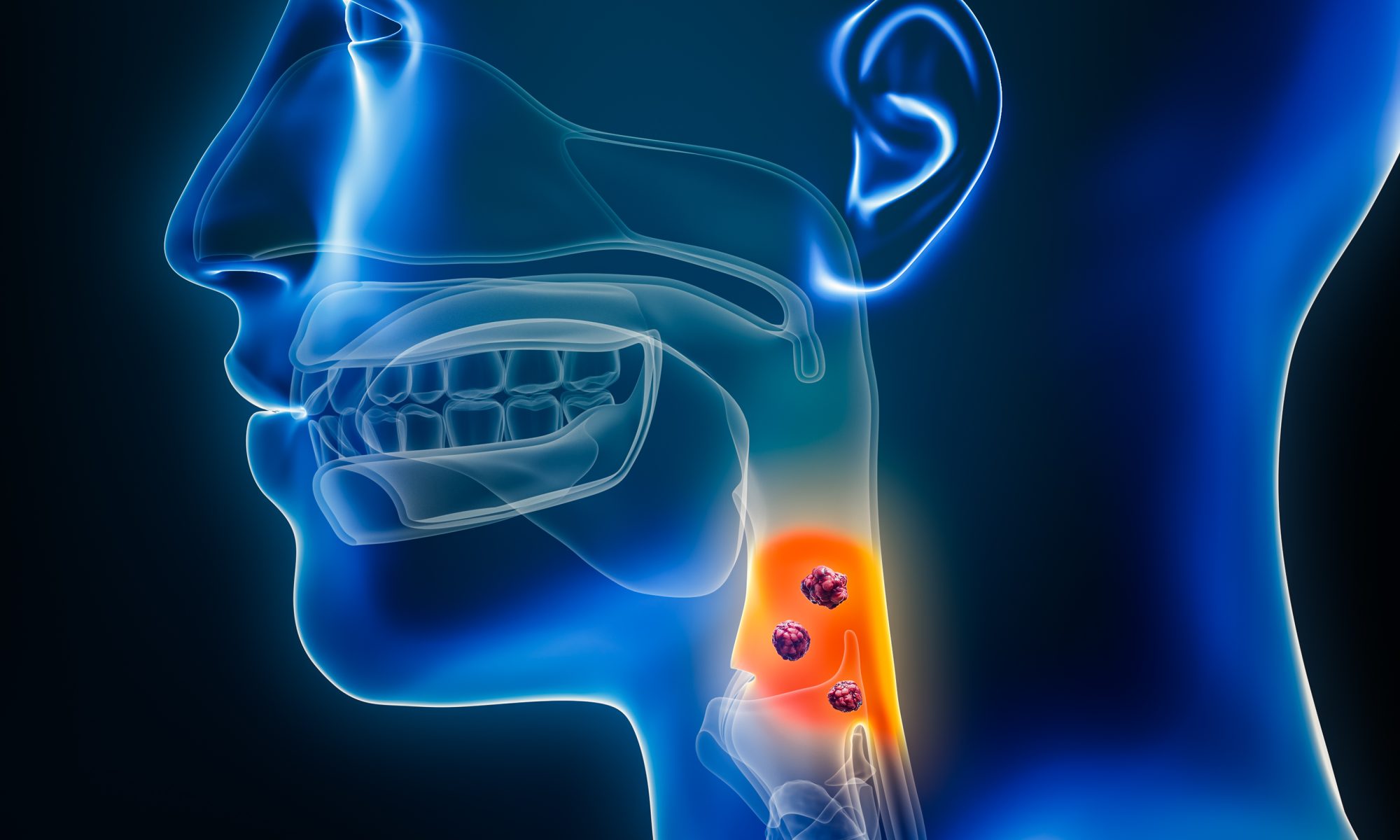 A medical illustration of the human head and neck highlights a tumor in the throat with glowing red markers, representing head and neck cancer, oncology research, and targeted cancer therapies.