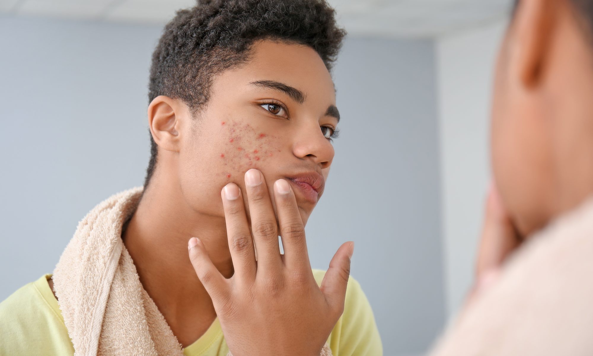 Young person examines facial acne in a mirror, representing Sagimet Biosciences’ Phase 3 development of denifanstat for moderate to severe acne.