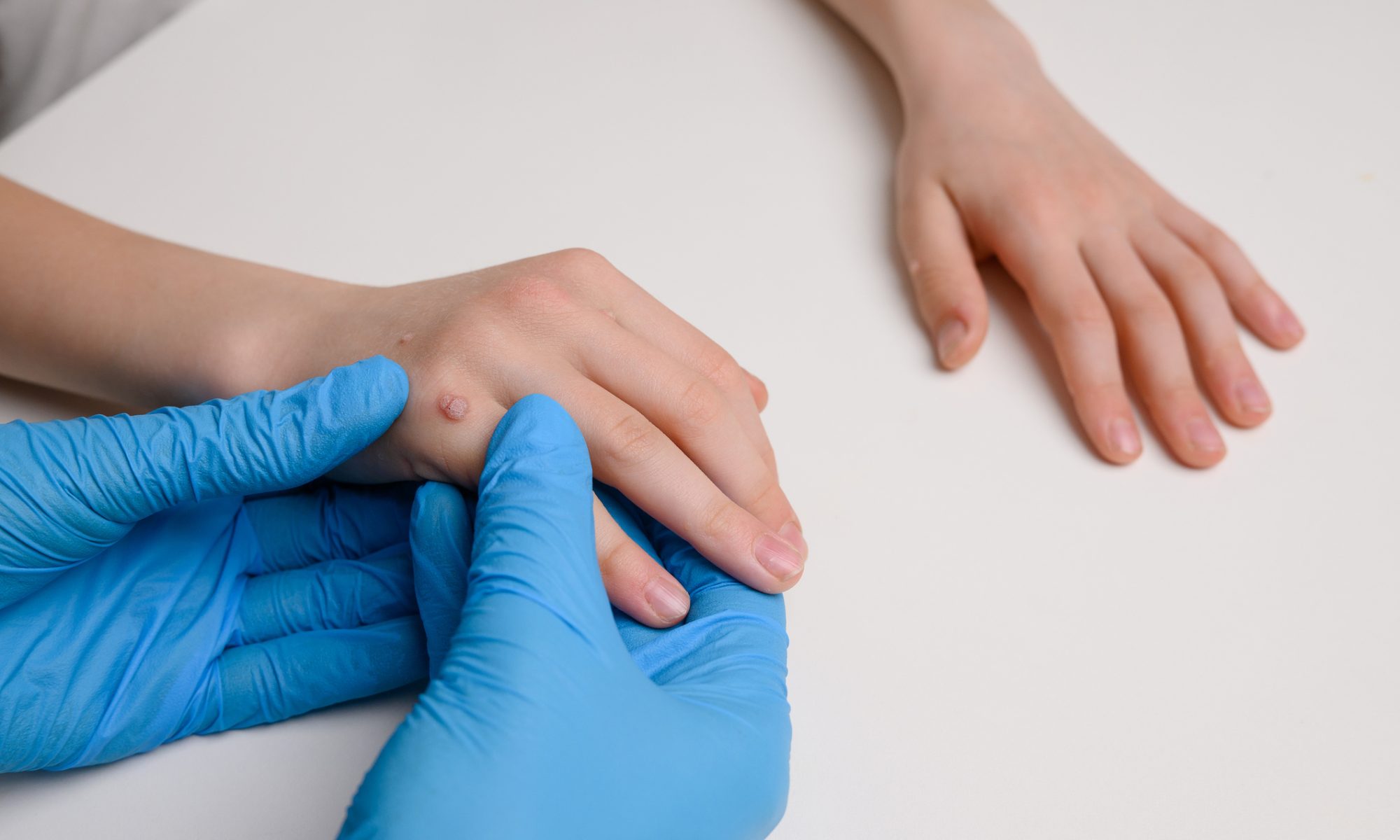 Healthcare professional wearing blue gloves examines a patient’s hand with a visible common wart, representing Verrica Pharmaceuticals’ Phase 3 clinical program evaluating YCANTH for common warts.