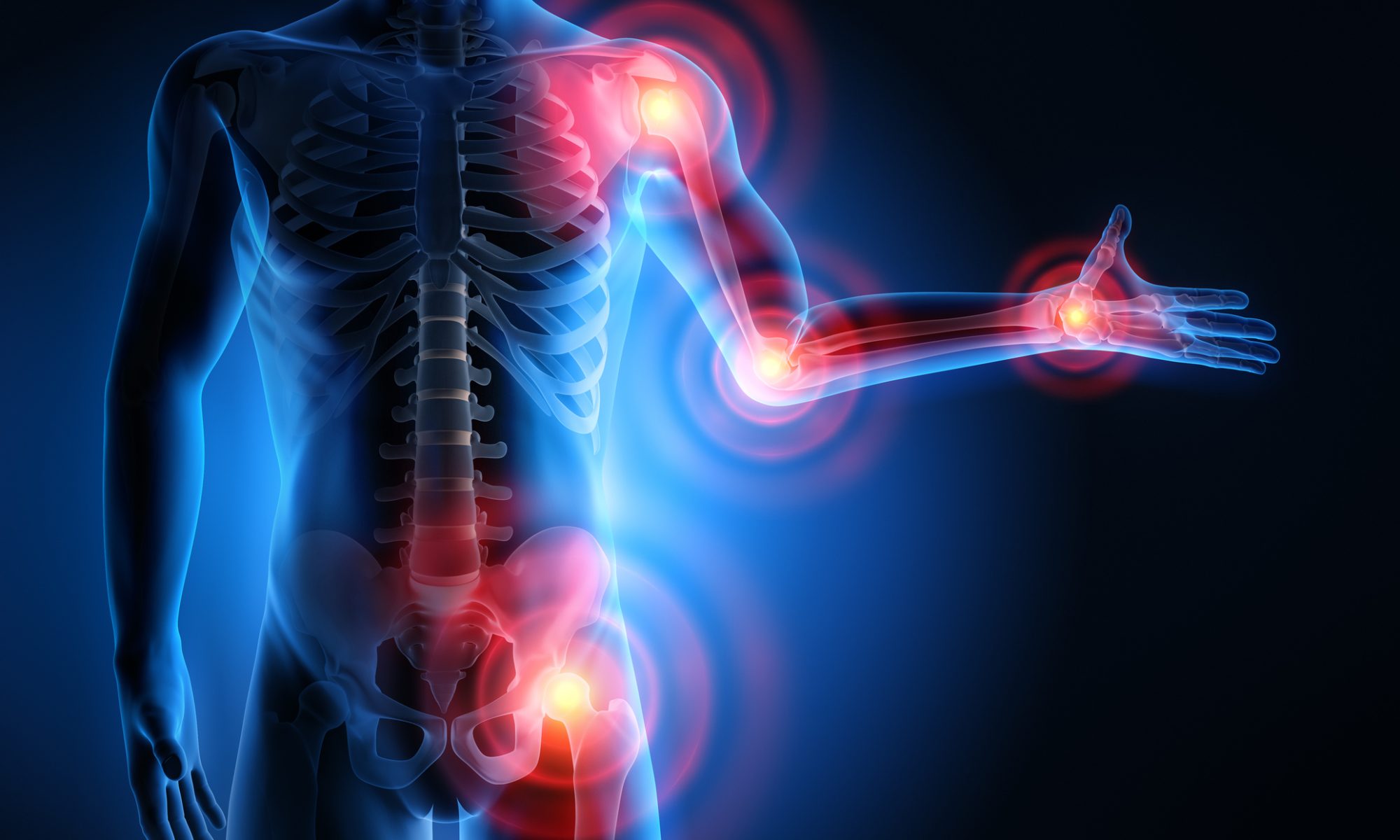 Medical illustration highlights inflammation and pain in the shoulder, elbow, wrist, and hip, representing MIRA Pharmaceuticals’ development of the non-opioid inflammatory-pain candidate MIRA-55.