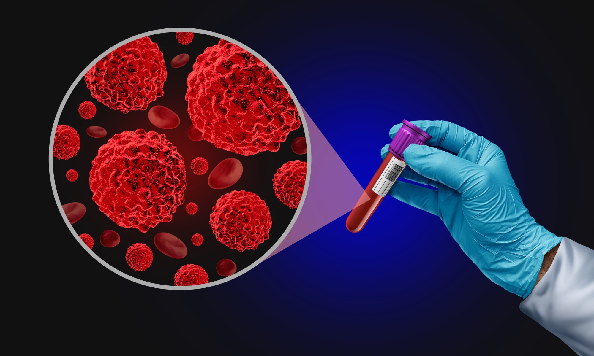 Blood sample and magnified cancer cells representing research into new treatments for multiple myeloma.