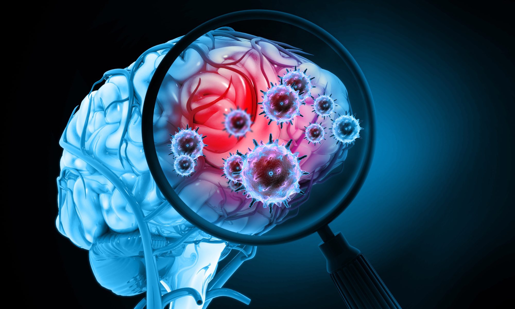 Illustration of a brain under magnification showing cancer cells, representing research into treatments for aggressive brain tumors.