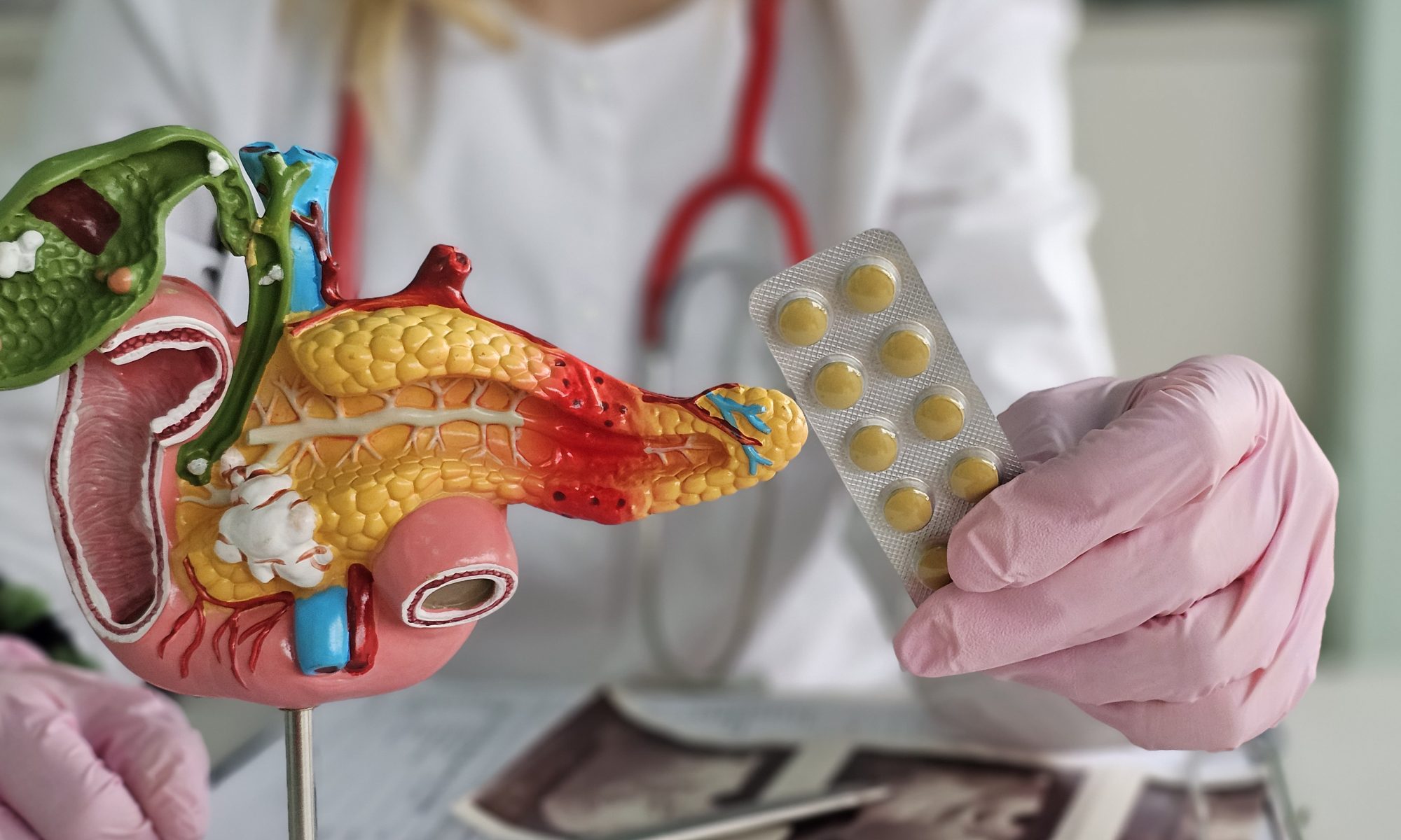 Healthcare professional holds a pancreatic anatomy model and medication, representing research into new combination therapies for pancreatic cancer.