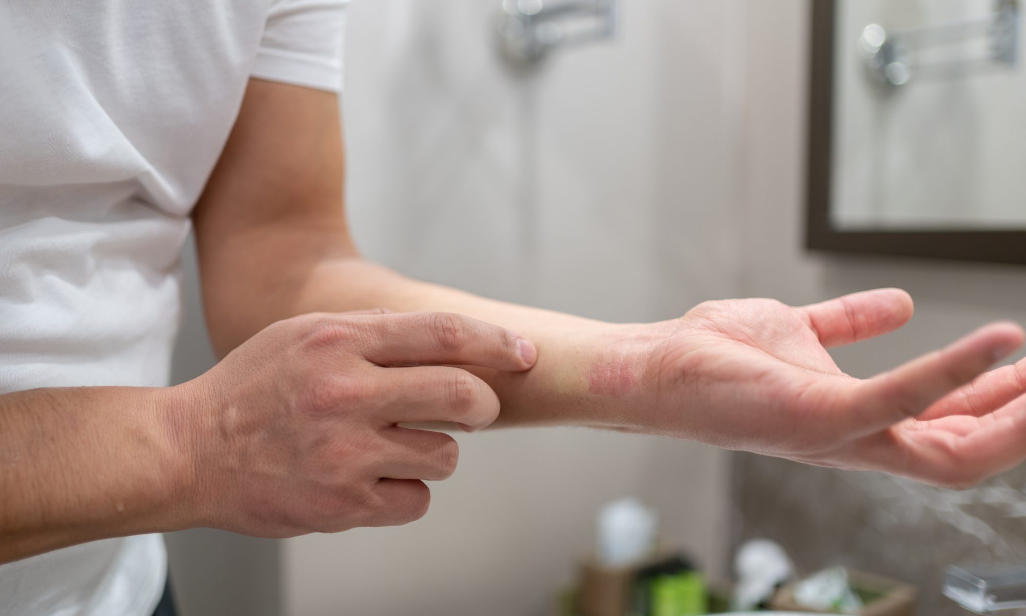 Person pointing to an irritated skin rash on the wrist, representing atopic dermatitis and the development of new treatments for inflammatory skin conditions.