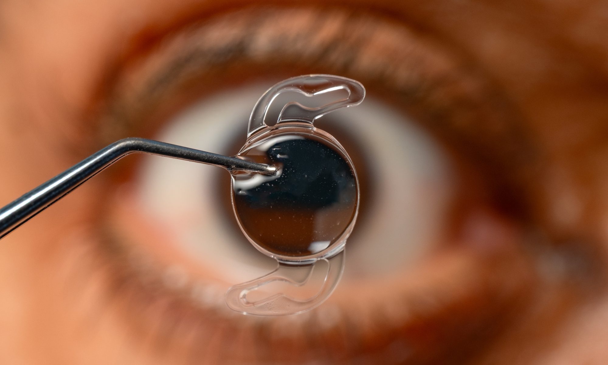 Close-up of an intraocular lens held in front of a human eye, representing STAAR Surgical’s implantable vision-correction technology.