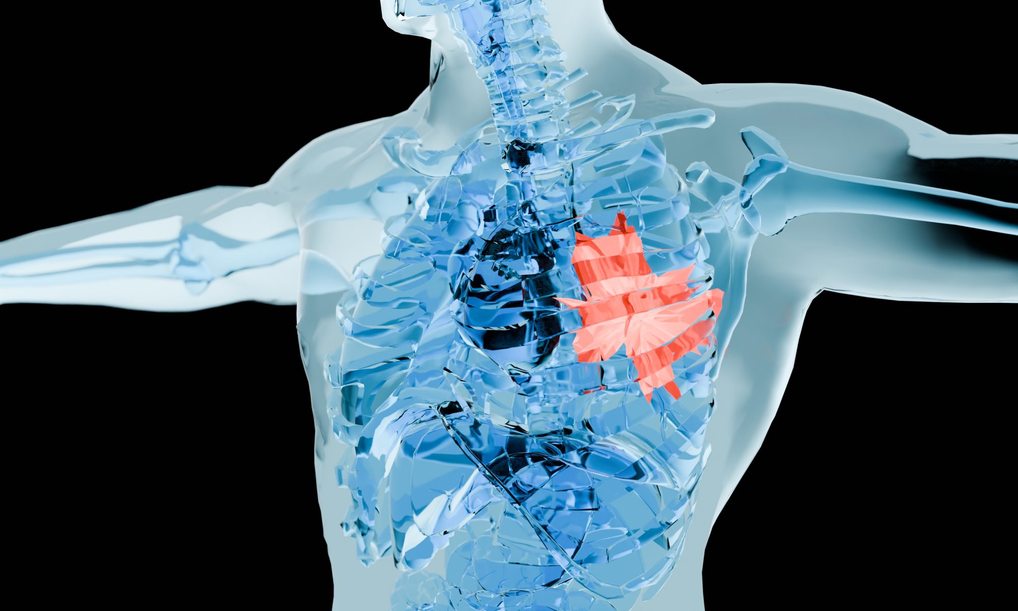 Medical illustration highlighting a blood clot in the lungs, representing pulmonary embolism and research into thrombectomy treatment outcomes.