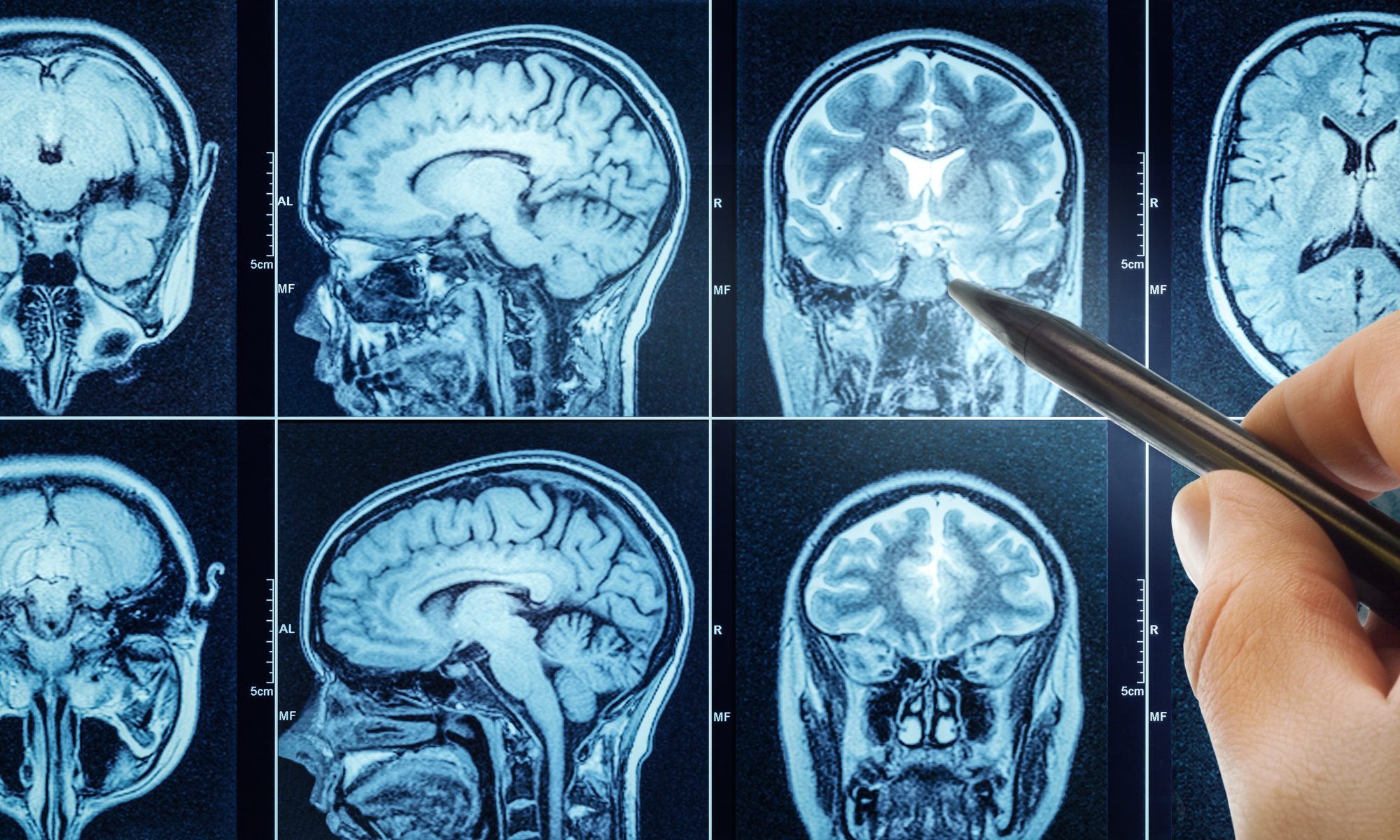 Telix Launches Pixclara in U.S. With First Commercial Brain Cancer Imaging Doses Key Points • Telix administered the first U.S. commercial doses of Pixclara at medical centers in Indianapolis and Cleveland. • Pixclara is the only FDA-approved radiopharmaceutical imaging drug for glioma, according to Telix. • The PET imaging drug helps distinguish recurrent or progressive glioma from treatment-related changes, alongside other diagnostic evaluations. • Its approved use includes adults and children one month of age and older. • PharmaLogic, Telix’s U.S. manufacturing and pharmacy distribution partner, is supplying finished unit doses.