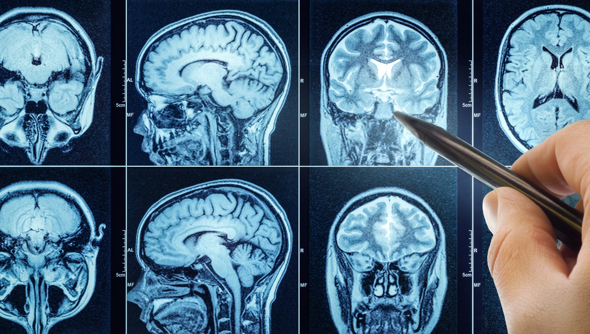 Telix Launches Pixclara in U.S. With First Commercial Brain Cancer Imaging Doses Key Points • Telix administered the first U.S. commercial doses of Pixclara at medical centers in Indianapolis and Cleveland. • Pixclara is the only FDA-approved radiopharmaceutical imaging drug for glioma, according to Telix. • The PET imaging drug helps distinguish recurrent or progressive glioma from treatment-related changes, alongside other diagnostic evaluations. • Its approved use includes adults and children one month of age and older. • PharmaLogic, Telix’s U.S. manufacturing and pharmacy distribution partner, is supplying finished unit doses.