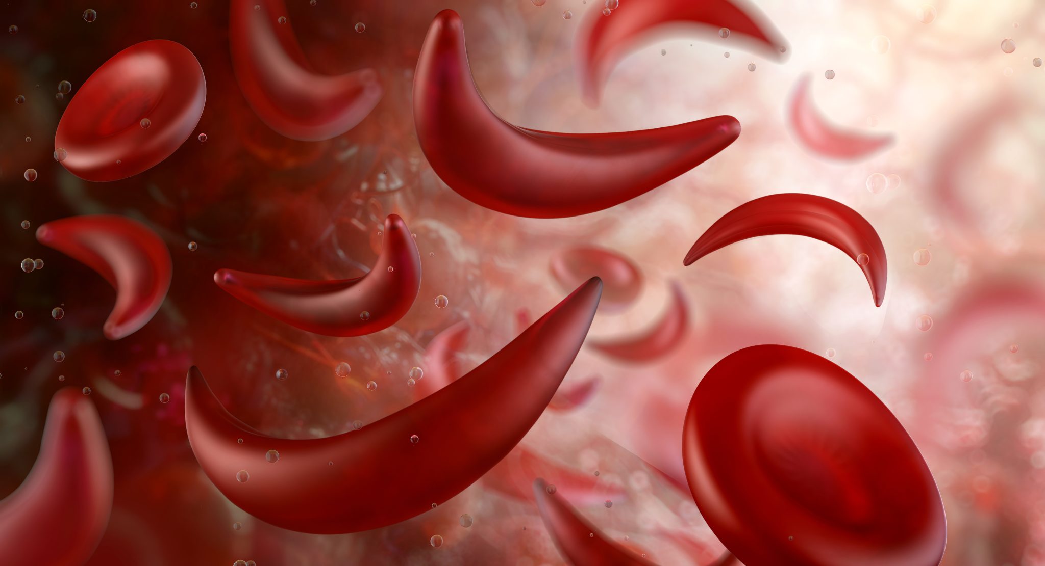 Medical illustration showing crescent-shaped sickle red blood cells alongside healthy red blood cells, representing sickle cell disease and research into new treatments.