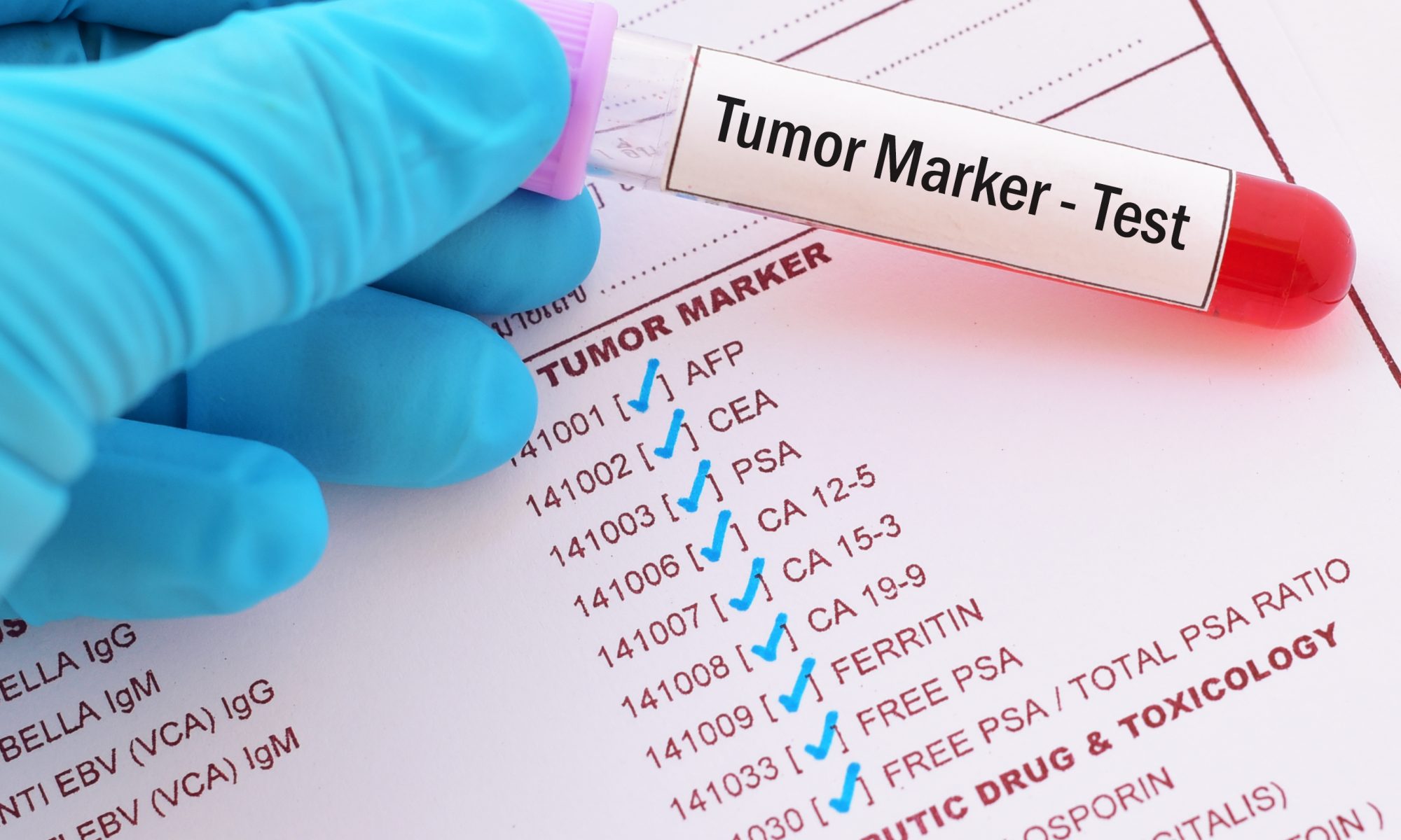 Healthcare professional holding a blood sample labeled "Tumor Marker - Test" over a laboratory testing form, illustrating cancer biomarker testing and precision oncology diagnostics.