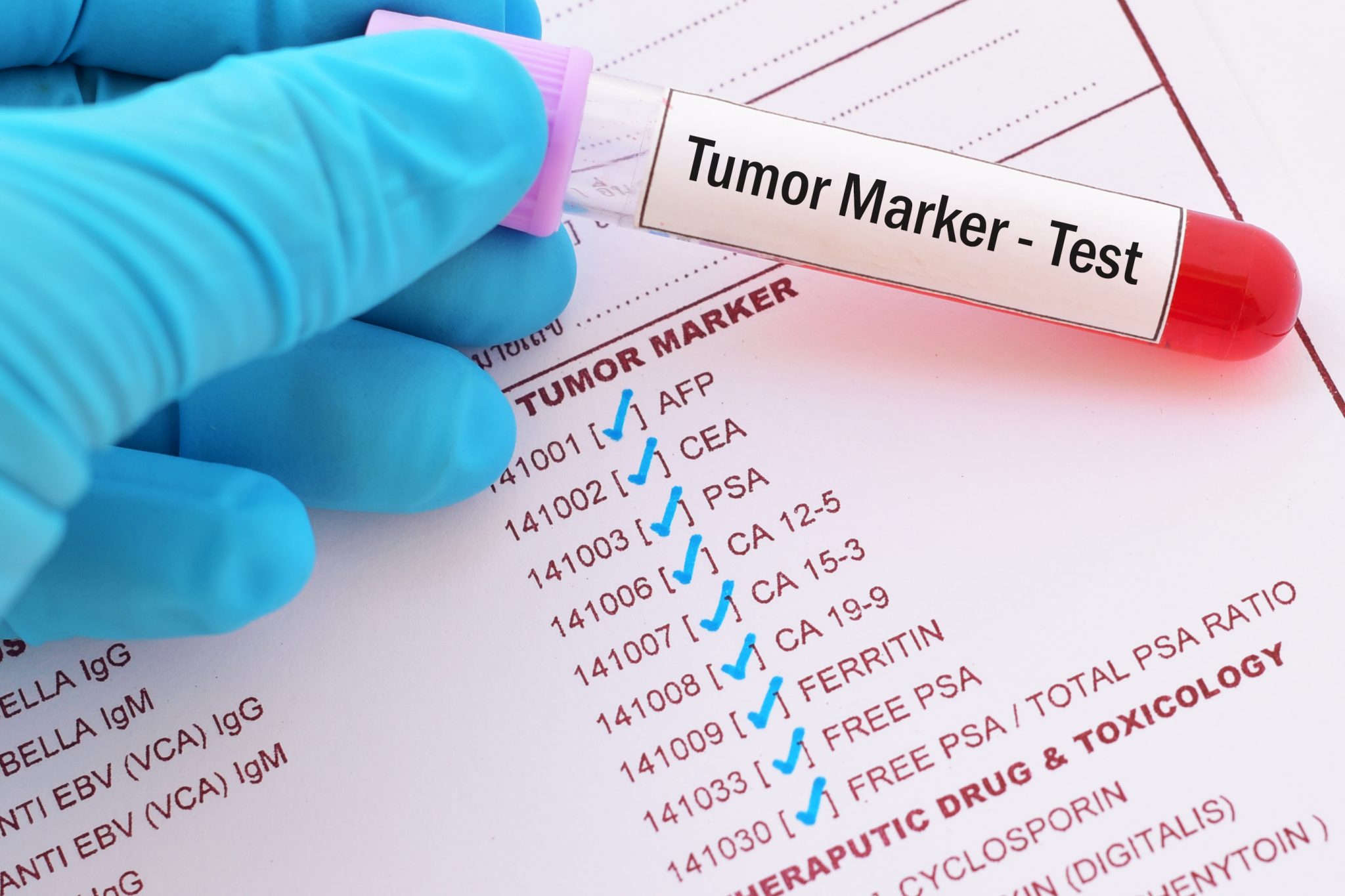 Healthcare professional holding a blood sample labeled "Tumor Marker - Test" over a laboratory testing form, illustrating cancer biomarker testing and precision oncology diagnostics.