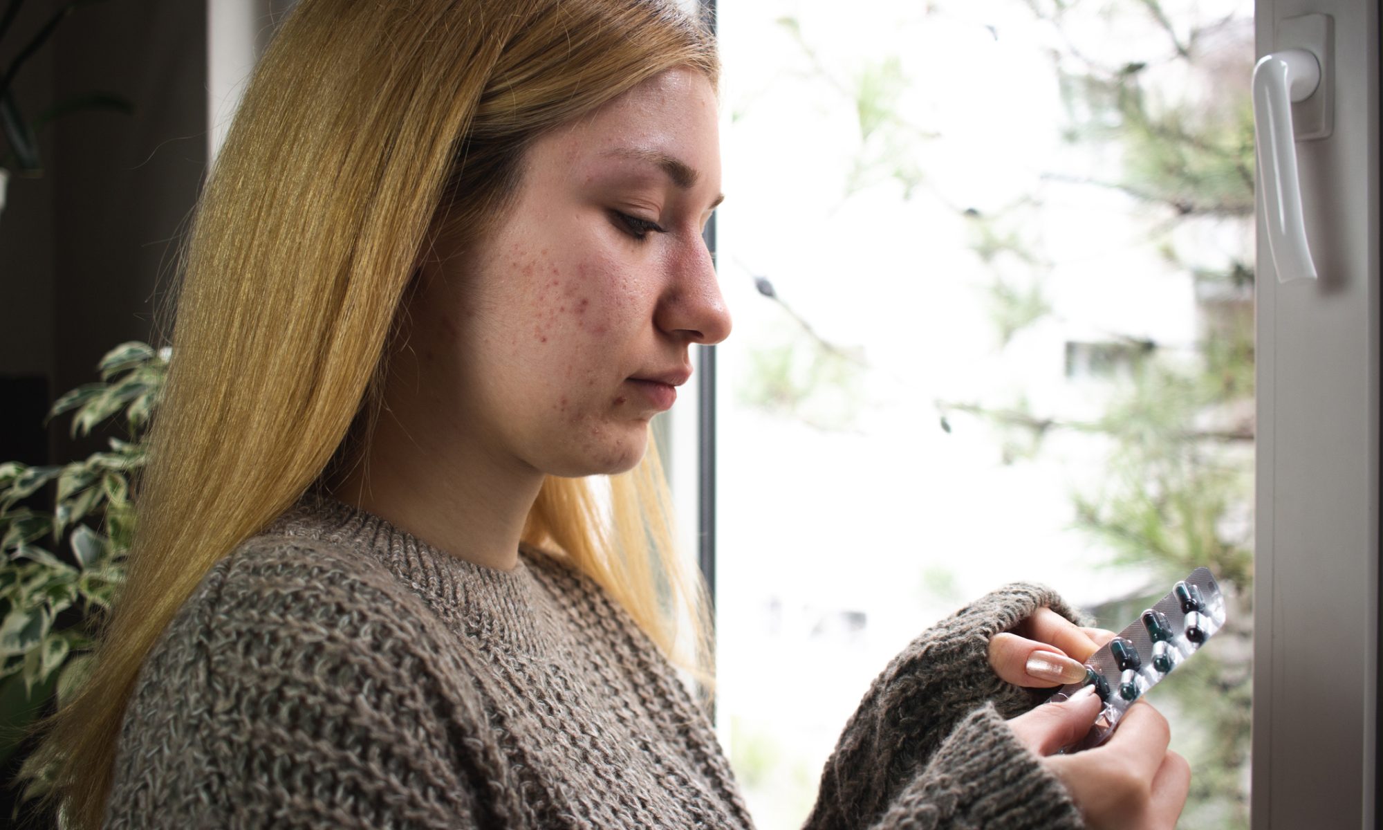 Young woman with visible facial acne examines a blister pack of medication while sitting near a window, illustrating acne treatment and dermatology research.