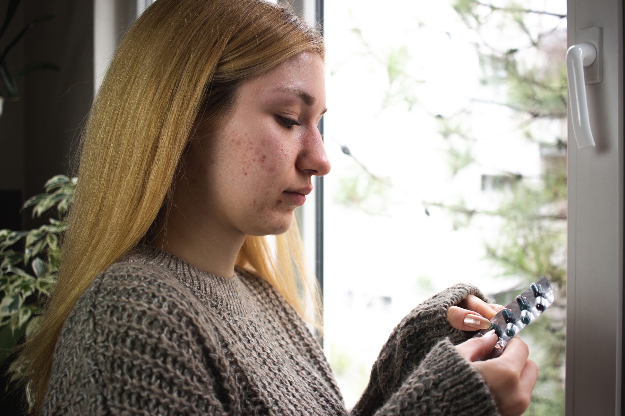Young woman with visible facial acne examines a blister pack of medication while sitting near a window, illustrating acne treatment and dermatology research.