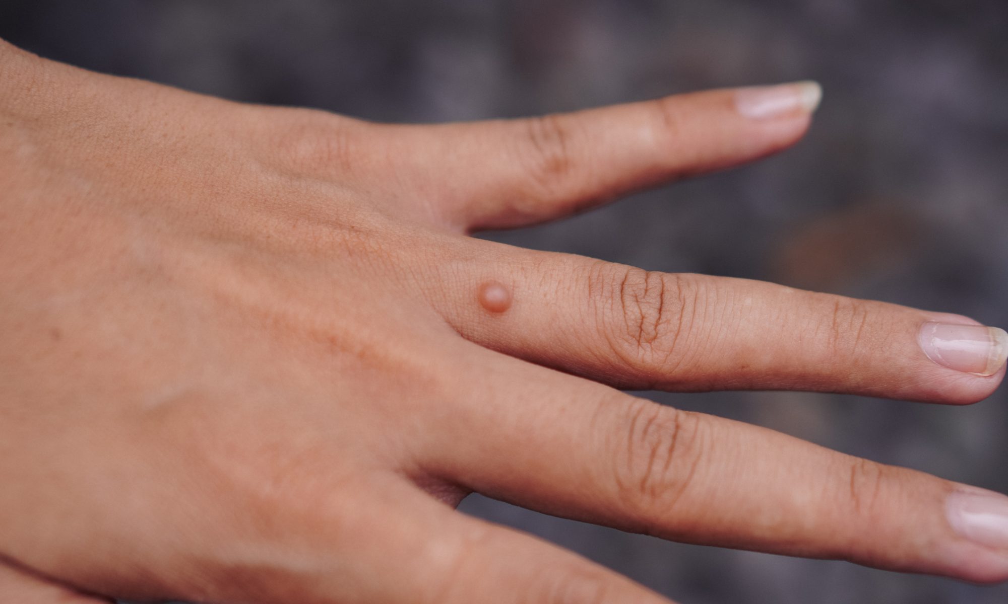 Close-up of a person's hand showing a small, raised skin bump resembling a common wart on the finger.