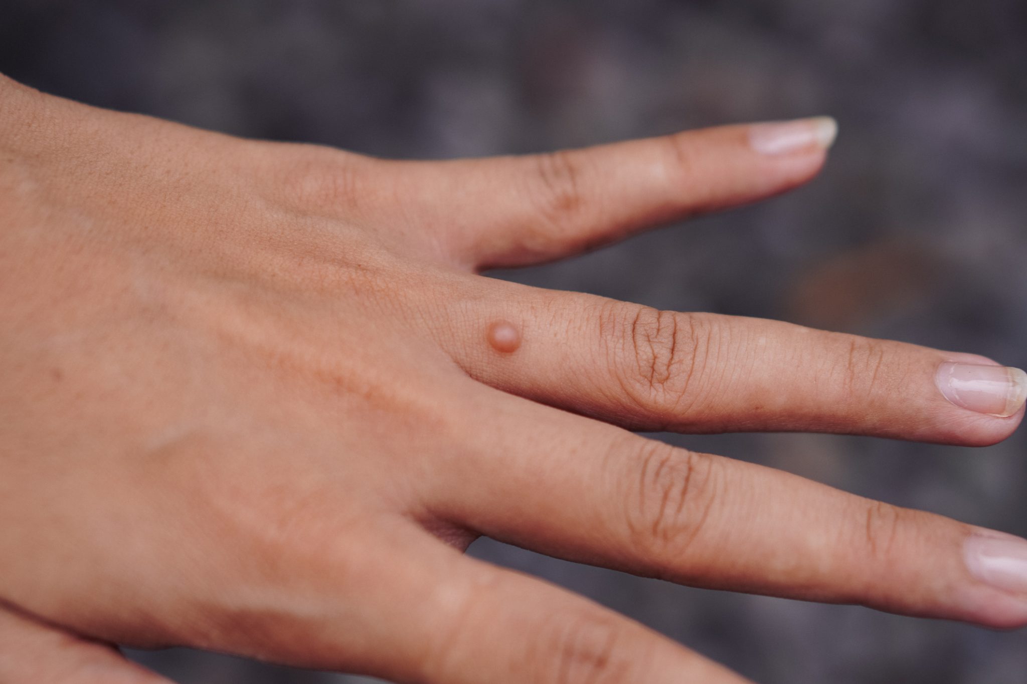 Close-up of a person's hand showing a small, raised skin bump resembling a common wart on the finger.
